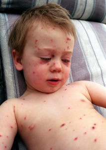 Child with measles, a potentially life-threatening disease